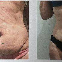 Comment se débarrasser des Bourrelets disgracieux et avoir une silhouette parfaite, nous avons la solution à Morhange en Moselle proche de Vic sur Seille Grostenquin et Baronville en Moselle