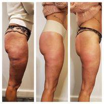 qu'elle traitement minceur est le plus efficace contre la cellulite  a Morhange proche de saint Avold en Moselle