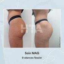 découvrez nos offres de soin minceur mag sculpt gainant et galbant pour hommes et femmes à Morhange proche de Saint Avold en Moselle