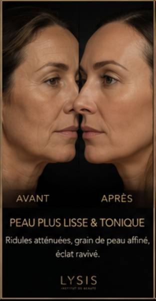 Bienfaits de la radiofréquence : Pourquoi choisir ce soin visage près de Guénange ?