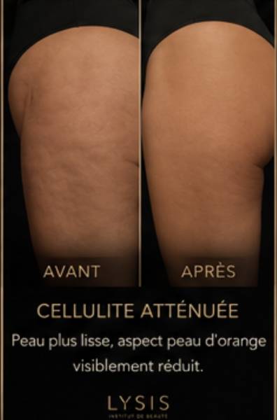 Quel traitement minceur est le plus efficace contre la cellulite à Richemont proche de Thionville
